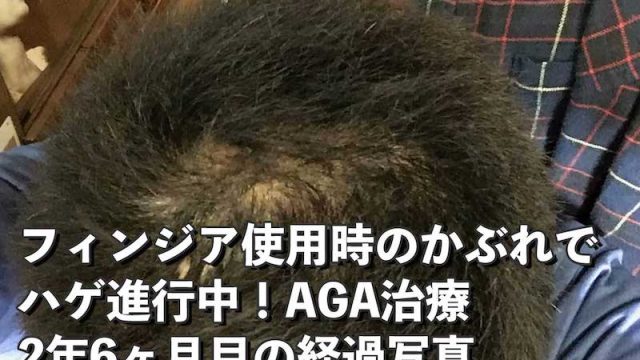 AGA治療開始912日目