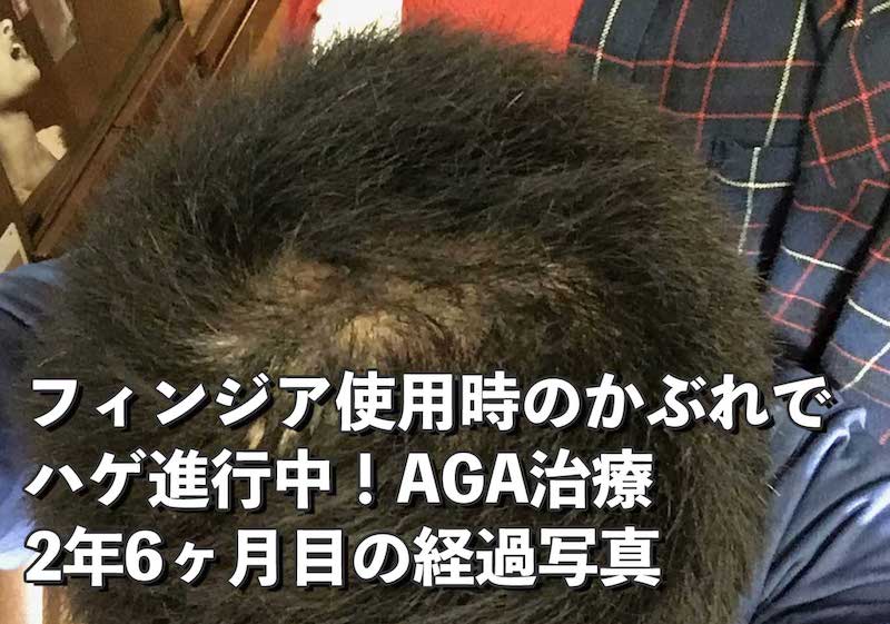 AGA治療開始912日目